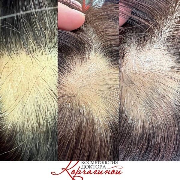 PRP плазмотерапия волос