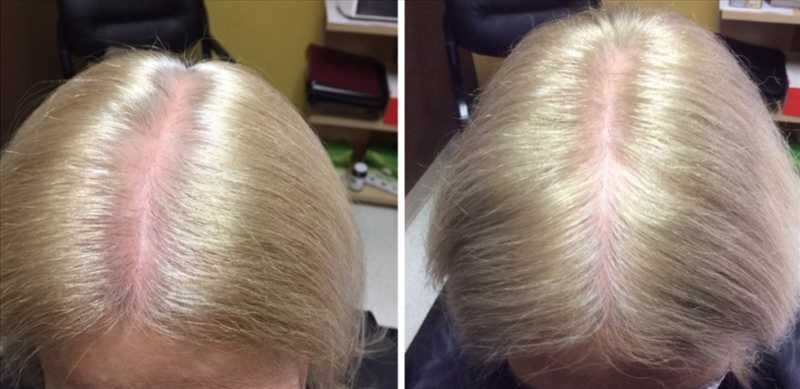 Мезотерапия волос фото до и после