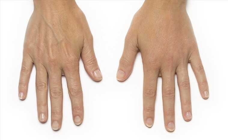 Омоложение кожи рук фото до и после