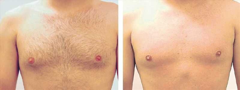 эпиляция лазером груди - фото до и после