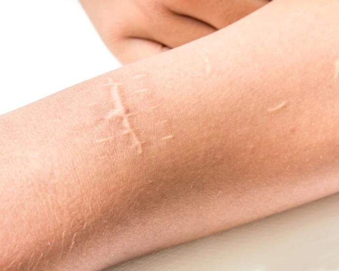 Коррекция шрамов и рубцов при помощи татуажа